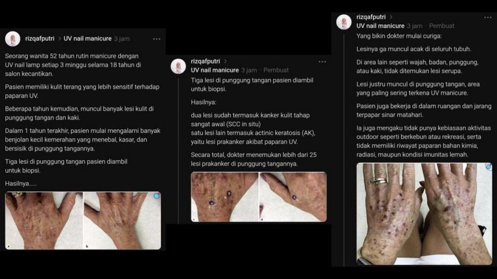 Dokter Ungkap Kasus Kanker Kulit Diduga Akibat UV Nail Lamp