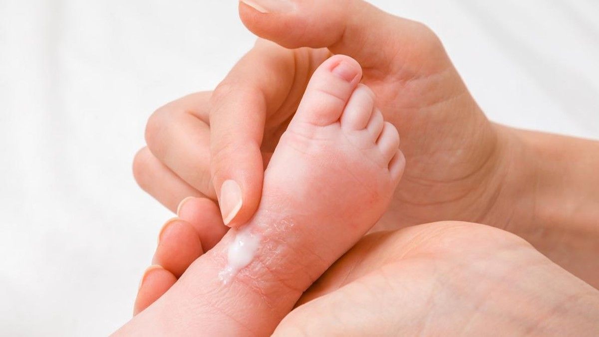 Mengatasi Kulit Bayi Mengelupas dengan Menjaga Kelembapan Alami
