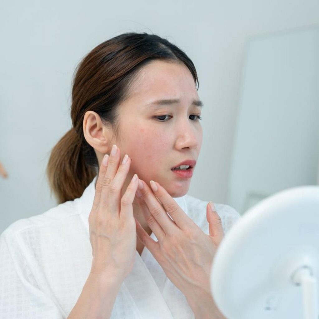 Chiamaka Okudoh Ketahui Kehamilan Setelah Alami Jerawat Hormonal Parah