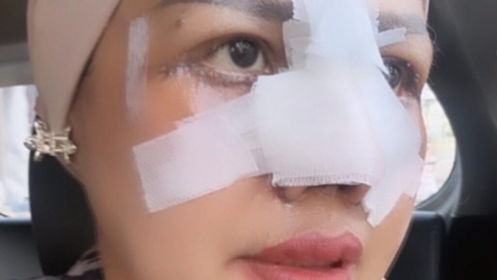 Elly Sugigi Jalani Operasi Plastik Hidung dan Mata Senilai Rp85 Juta