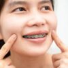 Dokter Gigi Jelaskan Fenomena Iyup pada Pemakai Behel Baru