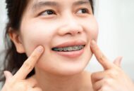 Dokter Gigi Jelaskan Fenomena Iyup pada Pemakai Behel Baru